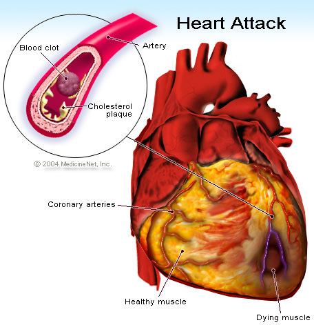 Heart attack Heart attack